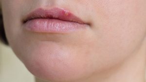 herpes